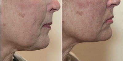 69 year old woman treated with Evoke - 69 year old female following a series of Evoke treatments of the face and neck