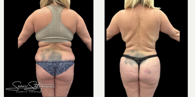 35-44 year old woman who is 3 months post-op from VASER assisted liposuction - 38 year old amazing patient that underwent VASER assisted liposculpting of the abdomen, flanks, upper/middle/lower back and a BBL procedure (fat transfer to the buttocks and lateral hips). Results shown are 3 months post-op.