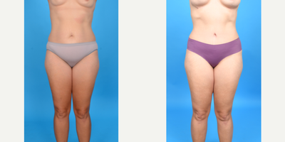 35-44 year old woman treated with Abdominal Etching, Diastasis Recti Repair, Drainless Tummy Tuck, Liposculpture, Liposuction, M - Tummy Tuck with Vaser ultrasound Lipo 360 as part of her mommy makeover. Lower bikini incision. Corset muscle plication. Vaser high def lipo.