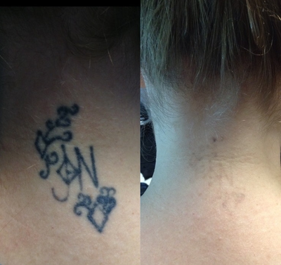 35-44 year old woman treated with Tattoo Removal - After photo taken post 4 enlighten laser tattoo removal treatments.