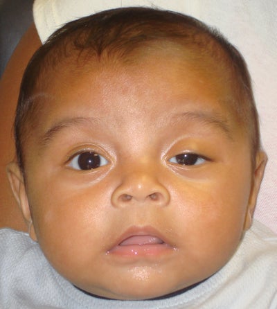 Congenital ptosis photo from Mehryar (Ray) Taban, MD, FACS, Los Angeles ...