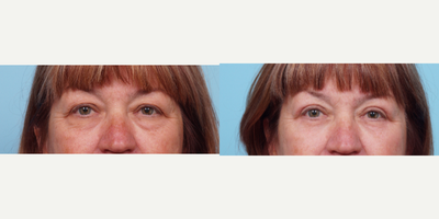 55-64 year old woman treated with Eyelid Surgery - This patient was bothered by her heavy eyelids. Dr. Balikian preformed and upper and lower Blepharoplasty 6 months ago. Her results are very natural and gave her a more refreshed look.