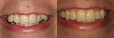 39 Year Old Female for Invisalign - This 39 year old female after Invisalign wanting to have a straighter more natural smile.