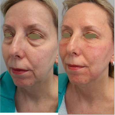 55-64 year old woman treated with Bellafill - Bellafill was used to restore lost volume.