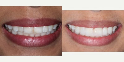 25-34 year old woman treated with Dental Bonding - 1. Deep Dental Cleaning: We begin with a thorough deep cleaning of your teeth, removing plaque, tartar, and bacteria from the gum line and between the teeth. This process helps prevent gum disease and promotes oral health.2. Teeth Whitening: Following the cleaning, we proceed with a professional teeth whitening treatment. This involves applying a bleaching agent to lighten and brighten your teeth, enhancing your smile's overall appearance.3. High-Esthetic Composite Edging: To complete the procedure, we apply high-quality composite resin to the edges of your teeth. This material matches your natural tooth color and is sculpted to create a seamless and aesthetically pleasing look, addressing issues like chipped or uneven teeth.