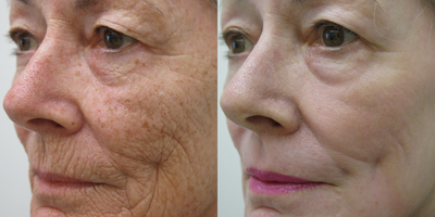 65-74 year old woman treated with a deep Chemical Peel - 70 year old female patient wishing to rejuvenate her skin and look natural. Before and 6 months after a deep chemical peel. Patient is very please with her results.