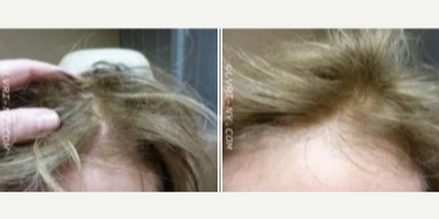 #4325-RS - Vampire Hair Regrowth - 69-year-old woman from Long Island wanted denser hair, despite being helped with Thyroid hormone replacement with another physician. Patient had one Vampire Hair Regrowth treatment. Post picture is 6 months later.