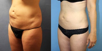 liposuction before bad lipo suction afters doctors