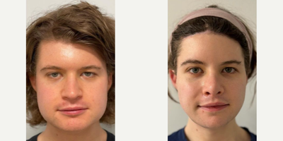 Patient treated with Facial Feminization Surgery, Rhinoplasty, Cheek Implants - This great patient of ours had FFS in October 2023. Procedures performed were: forehead contouring with hairline rounding and advancement, rhinoplasty, mandible contouring and cheek implants, lip lift, and augmentation.