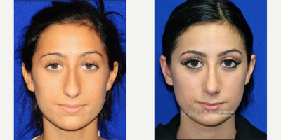 Woman treated with Rhinoplasty - Woman treated with Rhinoplasty