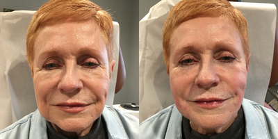 65-74 year old woman treated with Non Surgical Face Lift - This 71 year young lady was interested in a non-surgical solution to address the laxity she was seeing in her mid and lower face. Although she may consider surgery in the future, at this time she preferred something less invasive. She had good skin quality and tone due to her quality skin care program which includes chemical peels and regenerative medicine procedures such as the Vampire Facial. After meeting and discussing her concerns with Dr. Mahony, she decided that the PDO Thread Lift was the procedure for her.  The procedure took place in the office and was a breeze! After mapping out the areas to lift, she was injected with numbing medication to ease any pain. Using only 3 dissolvable PDO threads on each side of her face, she obtained immediate results! With the subtle lift to her cheeks and jawline, she came away with the refreshed look of her inner 40 year old true self!