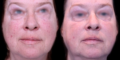 55-64 year old woman treated with Pulsed Dye Laser - This patient wanted to address overall redness on the face due to age/sun exposure due to acne. She underwent a series vascular laser treatments with Dr. Khorasani.