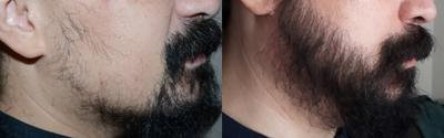 25-34 year old man treated with Beard Transplant - Before and after 2100 grafts to the beard