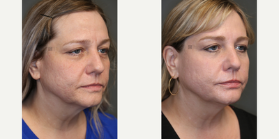 Laser Acne Scar Treatment - Laser acne scar treatment with fractional CO2 laser resurfacing