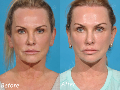 55-64 year old woman treated with Clear and Brilliant Skin Resurfacing - Lift and Fill Facelift: Face and Neck Lift with Fat Transfer and Skin Resurfacing