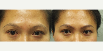 25-34 year old woman treated with Eyebrow Transplant - 7 days post op (note: Redness is almost gone.  Transplanted grafts are secure.  However, the transplanted grafts will eventually fall out before new hairs grow in.)