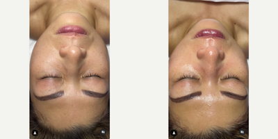 Woman treated with HydraFacial, Dermaplaning - Woman treated with HydraFacial, Dermaplaning