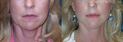 50 Year Old Female Treated with Facelift for Jowls and Sagging Neck - 
	At 50 years this patient's age was showing up primarily in her lower face, neck and jawline. A facelift/ Necklift very nicely smoothes the jowls, neck and cheek skin, without any stretched look.
