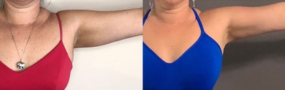 35-44 year old woman treated with i-Lipo - 35-44 year old woman treated with i-Lipo to arms