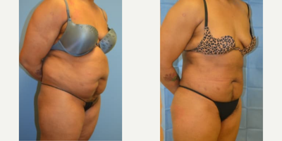 Woman treated with Smart Lipo - Woman treated with Smart Lipo