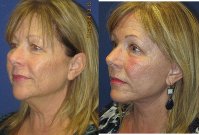 55 year old woman treated with Lower Face Lift, Neck Lift, and Upper Lid Blepharoplasty - 55 year old female seeking facial neck and eye rejuvenation. She had a lower facelift with neck lift and upper lid blepharoplasty under local anesthesia and oral sedation. Note the natural results of the jaw and neckline and youthful eyelid contour.