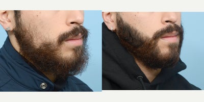 18-24 year old man treated with Hair Loss Treatment - Beard Transplant to fill in patches on cheeks.