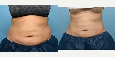 35-44 year old woman treated with Cryolipolysis - Combination 1 session CoolSculpting and a series of emsculpt for the abdomen and flanks.