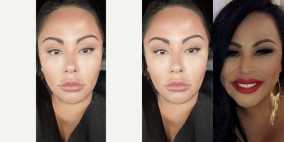 35-44 year old woman treated with Dimple Surgery - Timeless Dimple, Dimple Creation