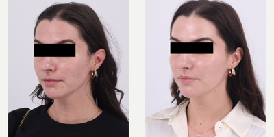25-34 year old woman treated with Moxi, Microneedling RF - Before and after 1 session of RF Microneedling and Moxi