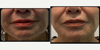 75 and up year old woman treated with Thread Lift - 75 Year old female, 3 Jaw Threads and perioral threads