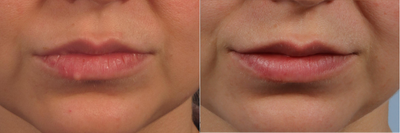 Removal of lip nevus - 
	Nevus (mole) removed from right lower lip with scar hidden in lip line.
