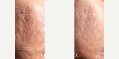 Acne Scars Combination Treatment with Scar Removal, CO2 Laser, TCA Peel, Sculptra, Subcision by Dr. Qazi - Acne Scars Combination Treatment with Scar Removal, CO2 Laser, TCA Peel, Sculptra, Subcision