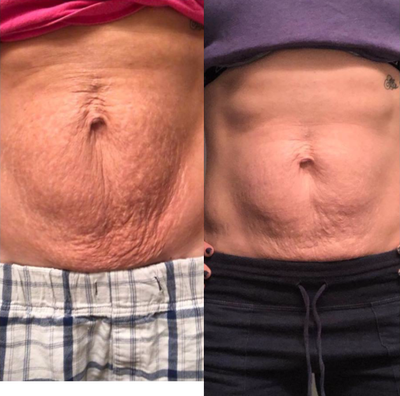 35-44 year old woman treated with TempSure Envi - This patient was seeking a non-surgical alternative to a tummy tuck. She is a cross fit coach and in fantastic shape, but hated the loose skin after pregnancy.