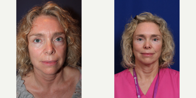 45-54 year old woman treated with Voluma - 2 syringes of voluma