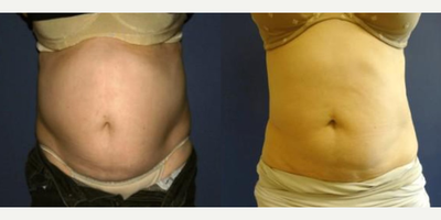 Woman treated with i-Lipo - Woman treated with i-Lipo