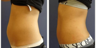 Woman treated with i-Lipo - Woman treated with i-Lipo