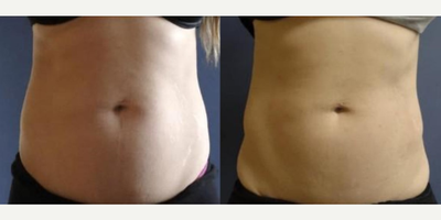 Woman treated with i-Lipo - Woman treated with i-Lipo