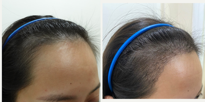 25-34 year old woman treated with DHI Hair Transplant, FUE Hair Transplant, Hair Transplant - A middle-aged Asian woman came in for a FUE hair transplant to lower her frontal hairline using 1,500 grafts. She hasn't been taking any medications for the hair loss.