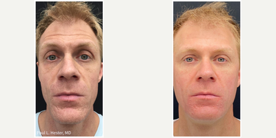 45-54 year old man treated with MiXto Laser - 