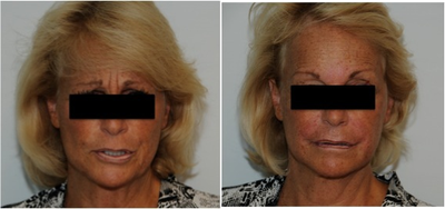 Evolence Injection in Glabella to Reduce Static Wrinkles - Patient had 0.8 cc of Evolence injected into her glabellar static wrinkles. Pictures show before and immediately after. Notice the significant reduction of her static wrinkles. 