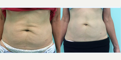 Woman treated with Skintyte - Woman treated with Skintyte