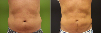 35-44 year old man treated with Tumescent Liposuction - This patient had Liposuction to his upper/lower abdomen and hip/flanks areas