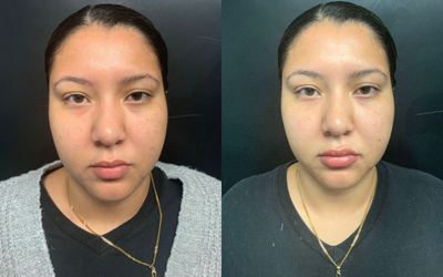 18-24 year old woman treated with Lip Augmentation - Lips enhancement with fillers.