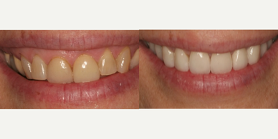 Patient treated with Teeth Whitening - A little less gummy and a lot more glam! Loving the results of this gummy smile fix