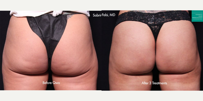 35-44 year old woman treated with Qwo - Qwo used to treat cellulite on the buttocks of a female patient.