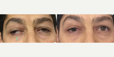 Woman treated with Strabismus Surgery - Surgical result of a patient with Paralytic strabismus due to CN3 (oculomotory nerve)palsy.