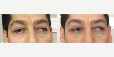 Woman treated with Strabismus Surgery - Surgical result of a patient with Paralytic strabismus due to CN3 (oculomotory nerve)palsy.