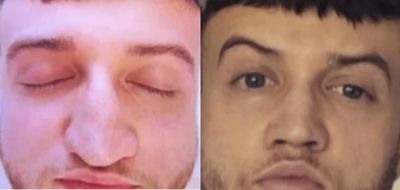 Man treated with Rhinoplasty - Man treated with Rhinoplasty. Patient disliked the shape and size of his nose for many years.