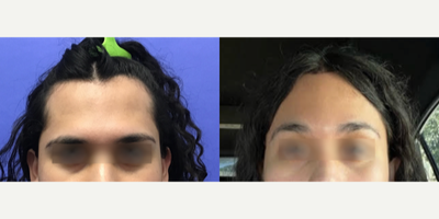 Patient treated with Brow Lift, Forehead Reduction - Forehead Lift, Hairline Lowering, Orbital Bony Contouring - 25 to 34 year-old female patient is 1 month post-op from Facial Feminization surgery. Her procedures included: Forehead Lift, Hairline Lowering, Orbital Bony Contouring, Septorhinoplasty (closed) with Cartilage Grafts and Weirs, Cheek Implants (small combined), and Chin Reduction and Contour with Soft Tissue Graft to Central Chin.