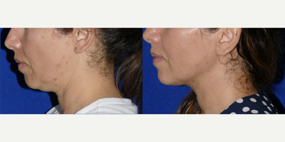 Woman treated with MyEllevate - Woman treated with MyEllevate